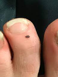 Melanomas may also grow in other organs, like your intestines and eyes, but that. Noticed This Black Mole Thing On My Toe Is This Melanoma Gotta Cut My Toe Nails Btw Melanoma