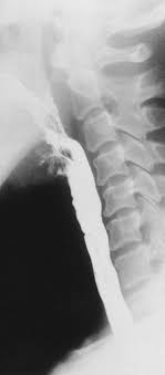 The syndrome is extremely rare. The Operation Of Upper Esophageal Web In Plummer Vinson Syndrome A Case Report Sciencedirect