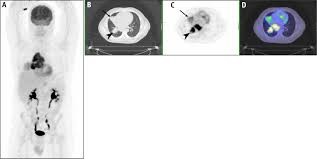 Owned by emmanuel care, st. Molecular Imaging Using Pet Ct For Radiation Therapy Planning For Adult Cancers Current Status And Expanding Applications International Journal Of Radiation Oncology Biology Physics