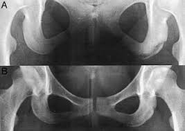 Image result for Pubic Apophysitis
