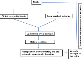 Image result for Stroke Pathophysiology