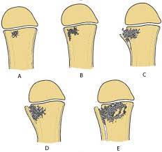 Image result for Osteomyelitis