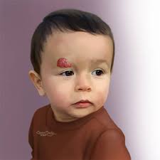 Progression means your cancer has grown or spread. Infantile Hemangioma Johns Hopkins Medicine