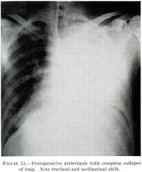 The nurses or respiratory therapists may guide you with some breathing exercises. Office Of Medical History