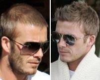 This procedure involves moving hair to thinning scalp areas from fuller areas. Celebrity Hair Loss