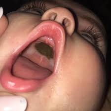 Canker sores look like ulcers with a grey, yellow, or white center and a flat, red border. Terrifying Dark Mark Inside Baby S Mouth Turns Out To Be Cardboard