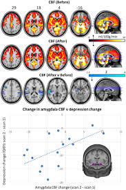 psilocybin for treatment resistant depression fmri measured