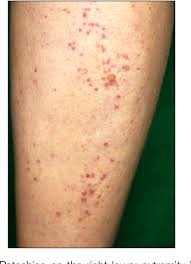 Image result for Microscopic Polyangiitis