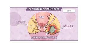 虎尾正峰診所(大腸直腸肛門外科、大腸鏡檢查、痔瘡、胃腸疾病）