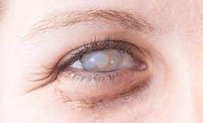 Hornhautentzundung Der Augen Keratitis Heilpraxis