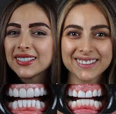 Reel by Dr.umit Kaya (@perfectsmile.turkiye) · May 11, 2023