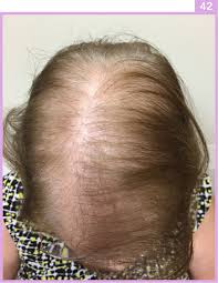 Dihydrotestosterone (dht) is the main hormone responsible for androgenetic alopecia in genetically susceptible individuals. Androgenetic Alopecia Plastic Surgery Key