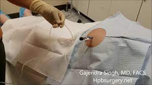 It can be used to remove excess fluid from the abdomen. Removal Abdominal Fluid Or Ascites Paracentesis Youtube