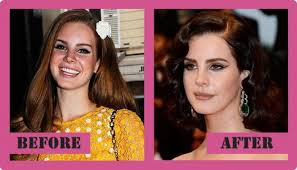 Lana del rey has been the subject of much controversy over the years about her looks changing her the years. Lana Del Rey Plastic Surgery Is Famous Singer S Look All Natural