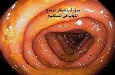 صحة أون لاين اللواط في الدبر مخاطر اللواط أو الجماع من الدبر