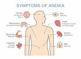 If you have anemia, tongue function and appearance can feel the effects almost as much as your energy signs and symptoms. Anemia Solving An All Too Common Mystery Biodesign Wellness Center 2021