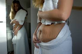 Gastric sleeve surgery is one the latest types of bariatric surgery. Panniculectomy Skin Removal Surgery Prep And Recovery