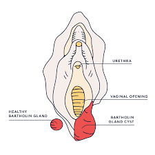 A number of techniques can be used to drain a bartholin's cyst or this will usually be removed before you go home. Swollen Vulva You May Have A Bartholin Cyst Daye Daye