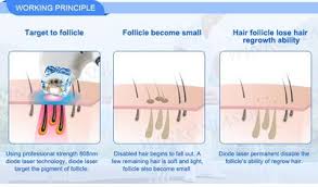 Laser hair removal prices are pretty steep. Laser Hair Removal Paradise Valley Kalologie Paradise Valley