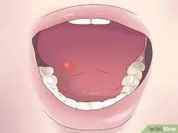 Erkennen Ob Du Mundkrebs Hast 15 Schritte Mit Bildern Wikihow