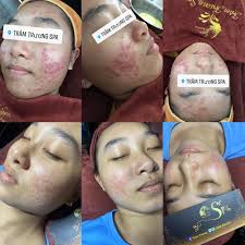 Top 11 spa trị mụn Phan thiết