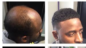 It can take up to a year for you to notice a dramatic difference in the overall thickness. Man Weaves A Game Changer For Balding Men Cash For 2 5 Billion Black Haircare Industry Npr