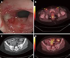 Colon cancer is the third most common cancer in men and women in the u.s. Colonography By Ct Mri And Pet Ct Combined With Conventional Colonoscopy In Colorectal Cancer Screening And Staging