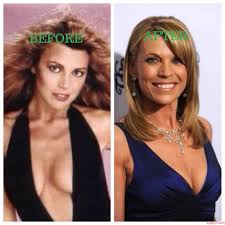 Image von vanna white plastic surgery featured young with the resolution von 1440x901 hinzugefügt von sayer_41. Surgery4 Page 6 Of 14 Celebs Plastic Surgeries Pics Before After