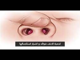 لحمية الانف فوائد و اضرار استئصالها مع الدكتور نور الدين الدحان youtube