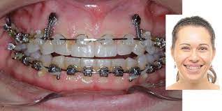 Options for gummy smile correction braces or invisalign if the positioning of the teeth and jaw are making your gums stick out and look more prominent such as in the case of an overbite braces or invisalign can be helpful. Gummy Smile An Often Untreated Condition Orthodontic Practice Us