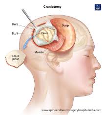 Pin On Neurosurgery