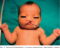 PDF] A case of partial trisomy 3p syndrome with rare clinical  manifestations