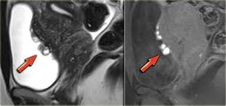 Laparoscopy remains the gold standard for diagnosis of endometriosis, although is an invasive procedure that has the potential to be hindered by obliterative disease. Endometriosis On Mri Shefalitayal