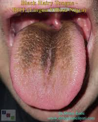 Image result for black hairy tongue symptoms