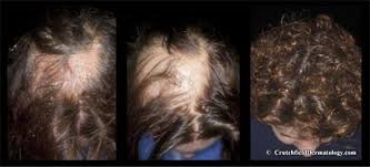 Seborrheic dermatitis is due to malassezia yeast, which feeds on oils. Dry Scalp Dandruff Seborrheic Dermatitis