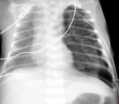 Thymus can fill the whole of upper mediastinum or is prominent. Pediatric Radiology