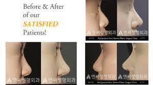 How much are household products in south korea? Rhinoplasty In Korea Procedure Recovery Cost In Korea Answer Plastic Surgery