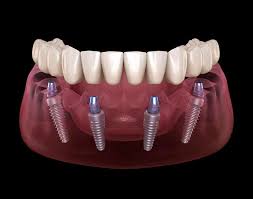 All On Four | Six - Medicadent Ağız ve Diş Sağlığı Polikliniği