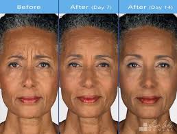 How often should you get botox after your first injection? You Could Have Your Botox Treatment Delivered By Your Trusting Dental Family Photographs Are For Informat Botox Before And After Botox Botox Injections