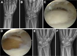 Wristwidget - Ulnar Impaction Syndrome (Uis) Also Has A... | Facebook