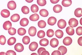 Image result for Peripheral Smear