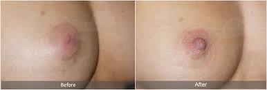 Image result for Nipple Inversion