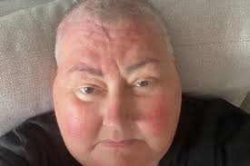 Leamington woman thought she had Long Covid but it was actually a brain  tumour