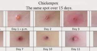 Kitten seperti yang kita ketahui sangatlah rentan terhadap penyakit, tetapi kamu tidak perlu panik akan… cara memelihara kelinci. Tips Merawat Chicken Pox Di Rumah Supaya Cepat Sembuh