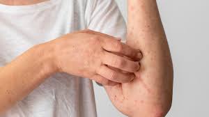 Image result for Photodermatitis
