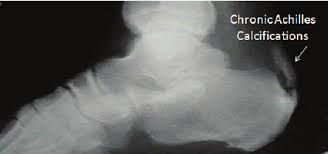 X Ray Showing Chronic Calcifications Of Achilles Ten Don Download Scientific Diagram