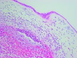 Image result for Chorioamnionitis