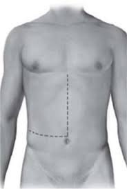 Maybe you would like to learn more about one of these? Standard Open Right Hepatectomy Intechopen