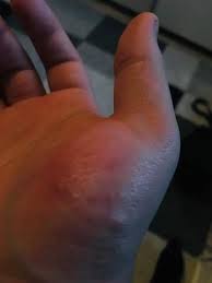 Hand Kleine Blaschen Juckreiz Gesundheit Und Medizin Gesundheit
