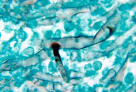 Se debe saber que la mucormicosis puede provocar una enfermedad aguda, de rápido avance y ocasionalmente mortal causada por diferentes hongos que se. El Hongo Negro La Amenaza Silenciosa De Algunos Infectados Con Covid Que Ha Activado Las Alertas Internacional Cadena Ser